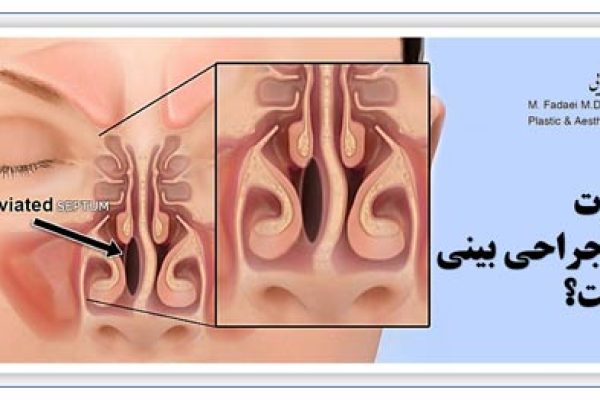 سپتوپلاستی و جراحی بینی