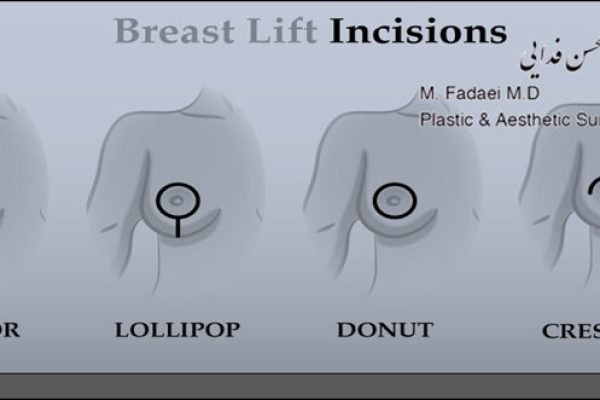 تکنیک های برش در جراحی لیفت سینه