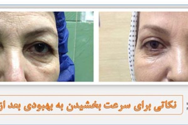 بهبودی بعد از جراحی پلک