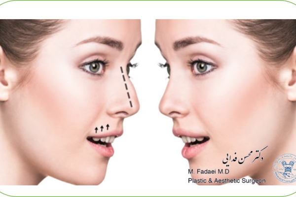 جراحی بینی استخوانی