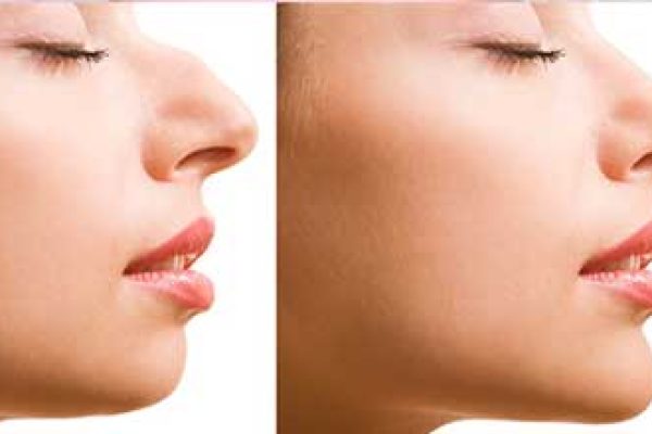 جراحی بینی استخوانی