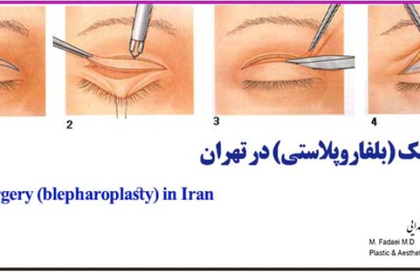 جراحی پلک (بلفاروپلاستی) - Eyelid Surgery (Blepharoplasty)