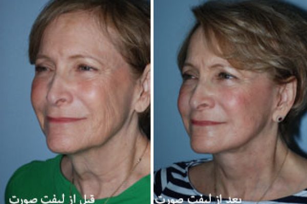 facelift-after-before