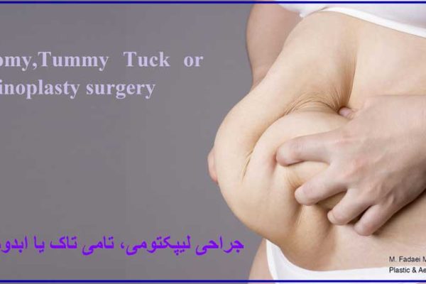 لیپکتومی ، تامی تاک ، ابدومینوپلاستی - Lipectomy , Tummy Tuck or abdominoplasty