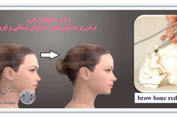 تراش استخوان ابرو - brow bone shaving
